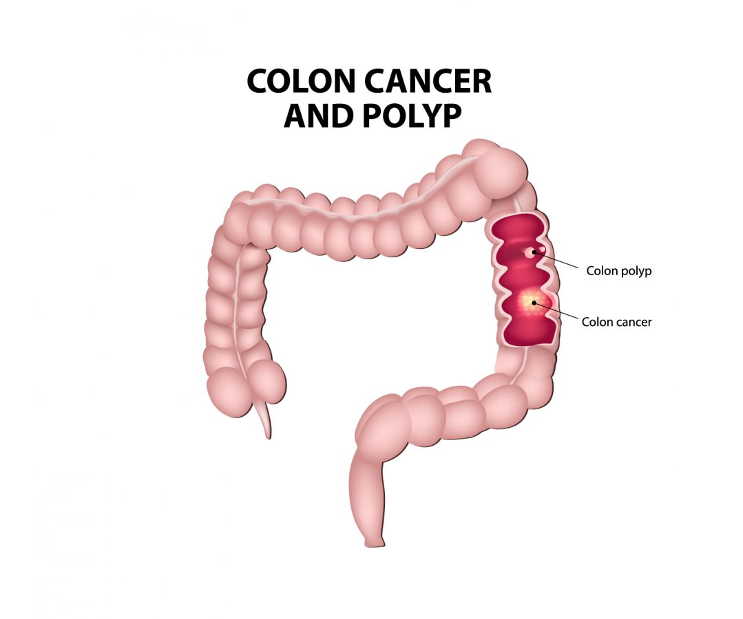 How Does Colon-Guard Offer a New Alternative to Screen for Polyps? - CHOP